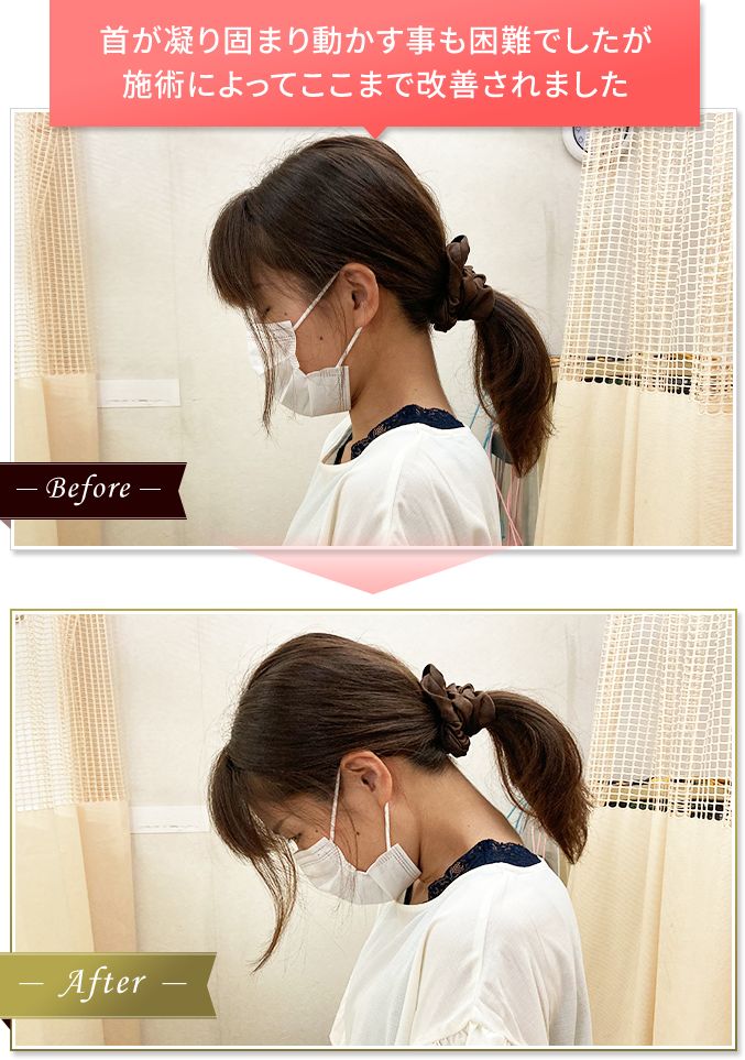 門真市にある当院の整体で凝り固まり動かす事も困難だった首が改善されました